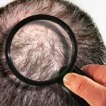 Alopecia Androgenética (Calvície)​